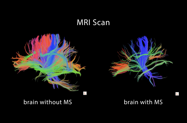 DTI Brain scan image with and without MS 