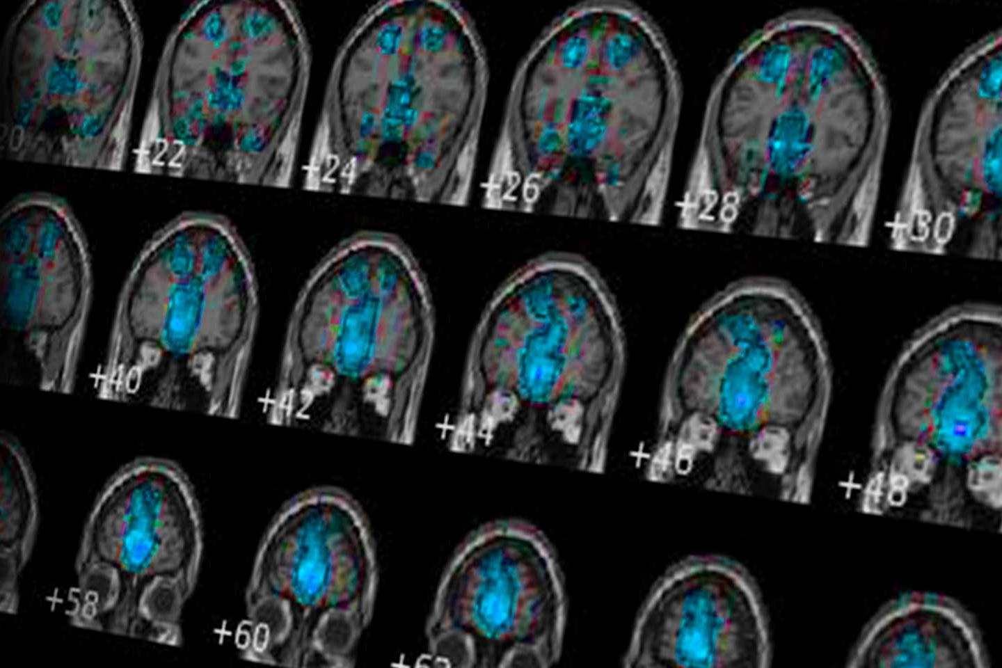 MRA test scan result of a human brain