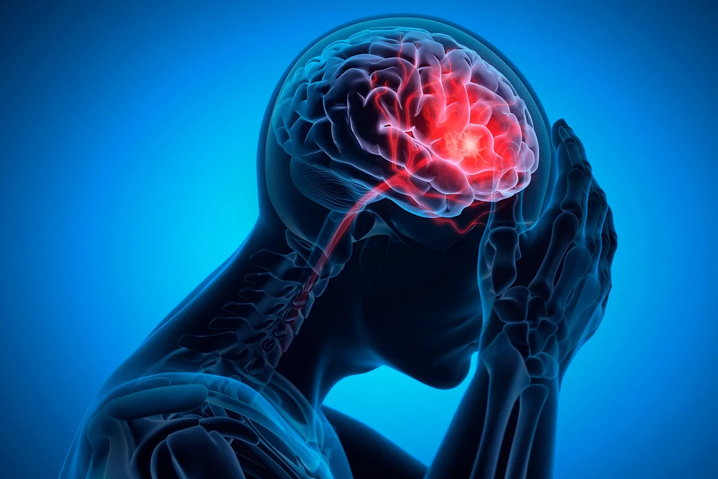 Graphic of skeleton head depicting how a right-sided stroke may affect the brain