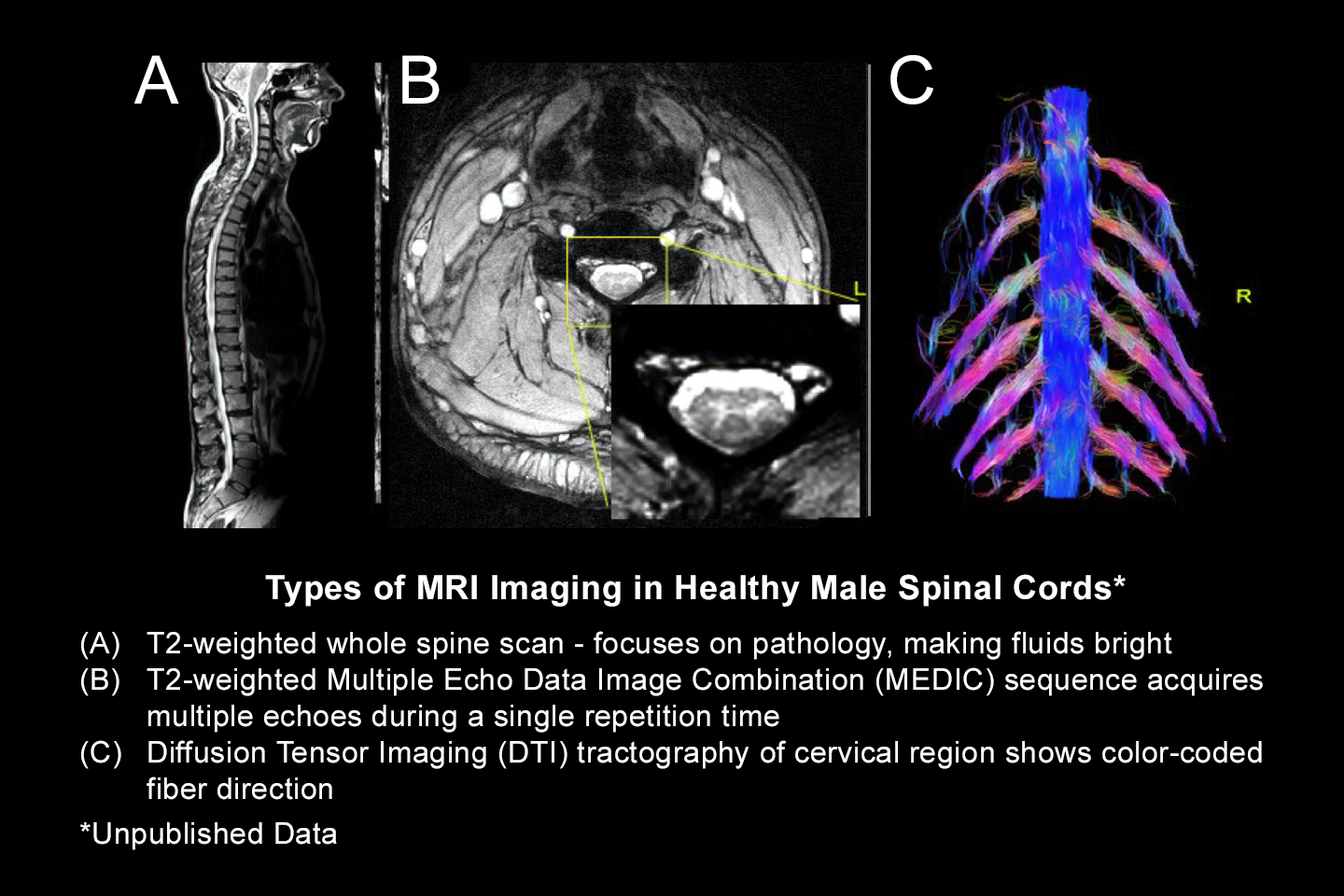image of MRI for a male spinal cord