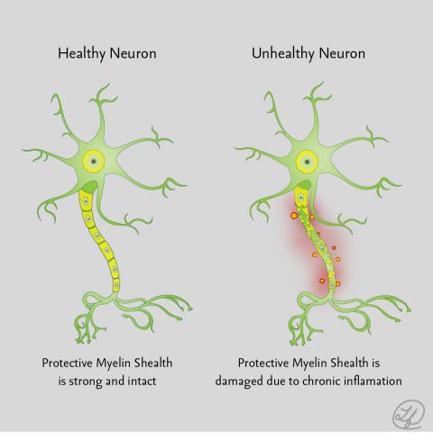 Illustration of the process of neuroinflammation including neuron with an axon and multiple dendrites
