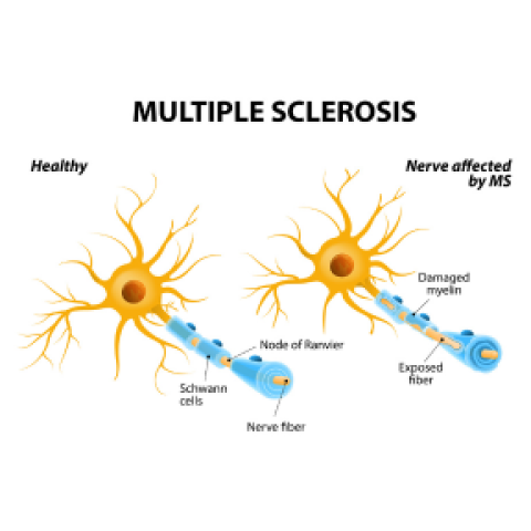 Diagram of a healthy nerve and then a nerve affected by multiple sclerosis.